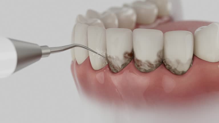 Trusted Wisdom Tooth Removal service in Pocatello, ID - Dentist Open Now